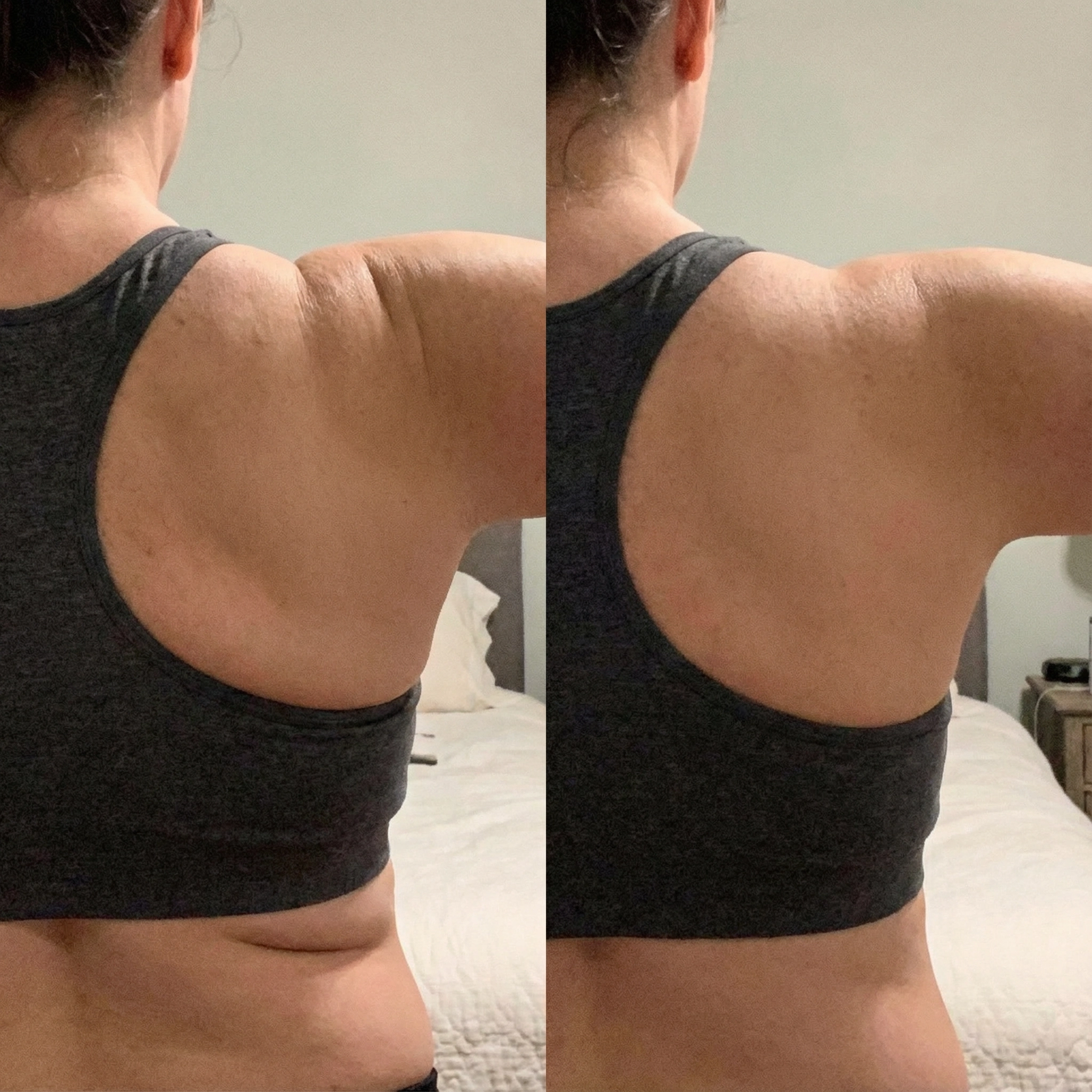 Vorher Nachher Rücken