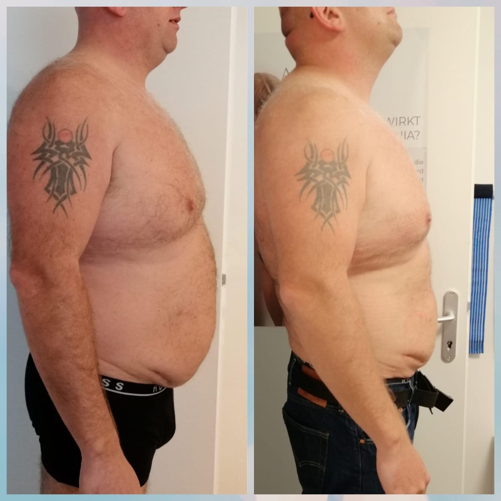 Vorher Nachher Männerbauch Groß