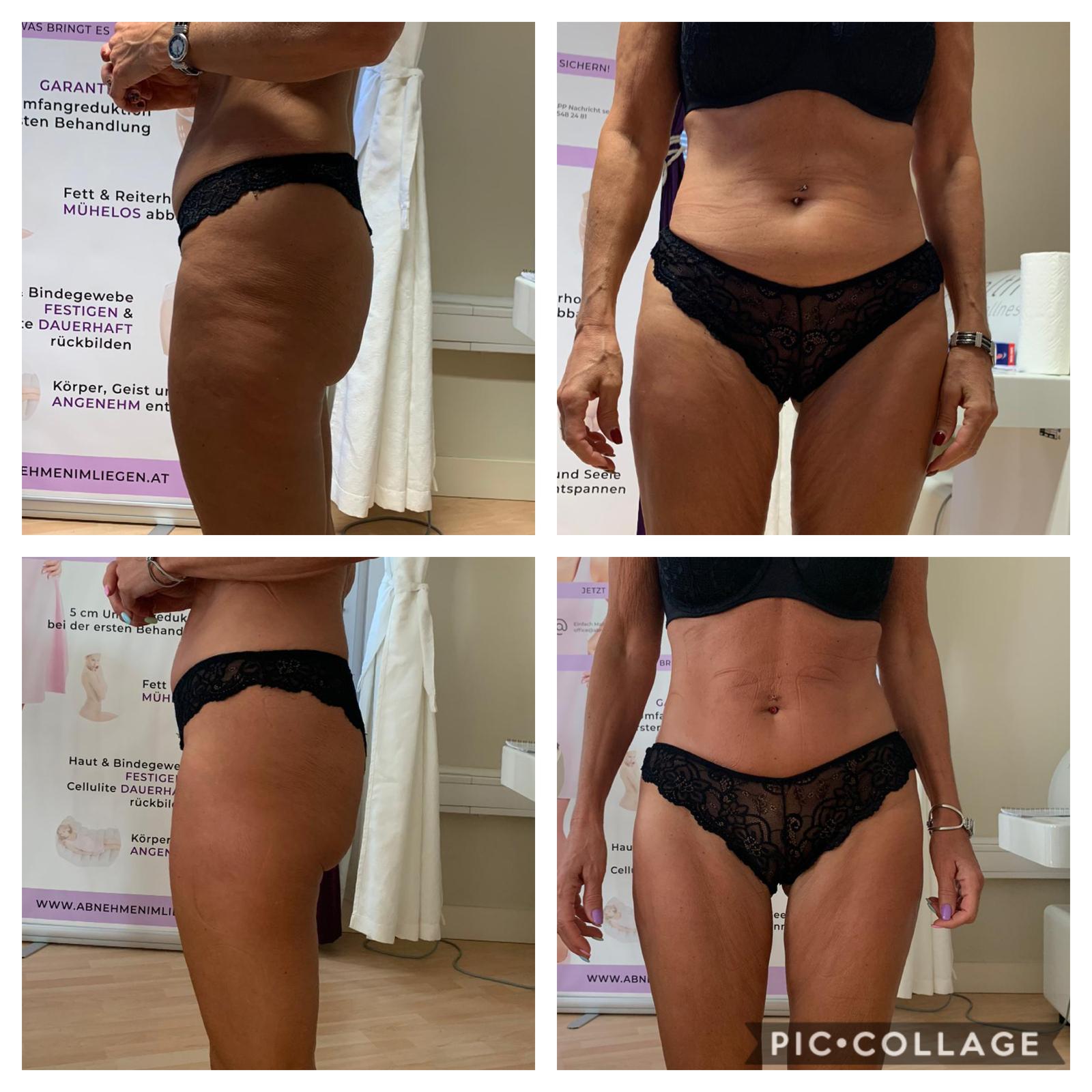 Vorher Nachher Po und Beine