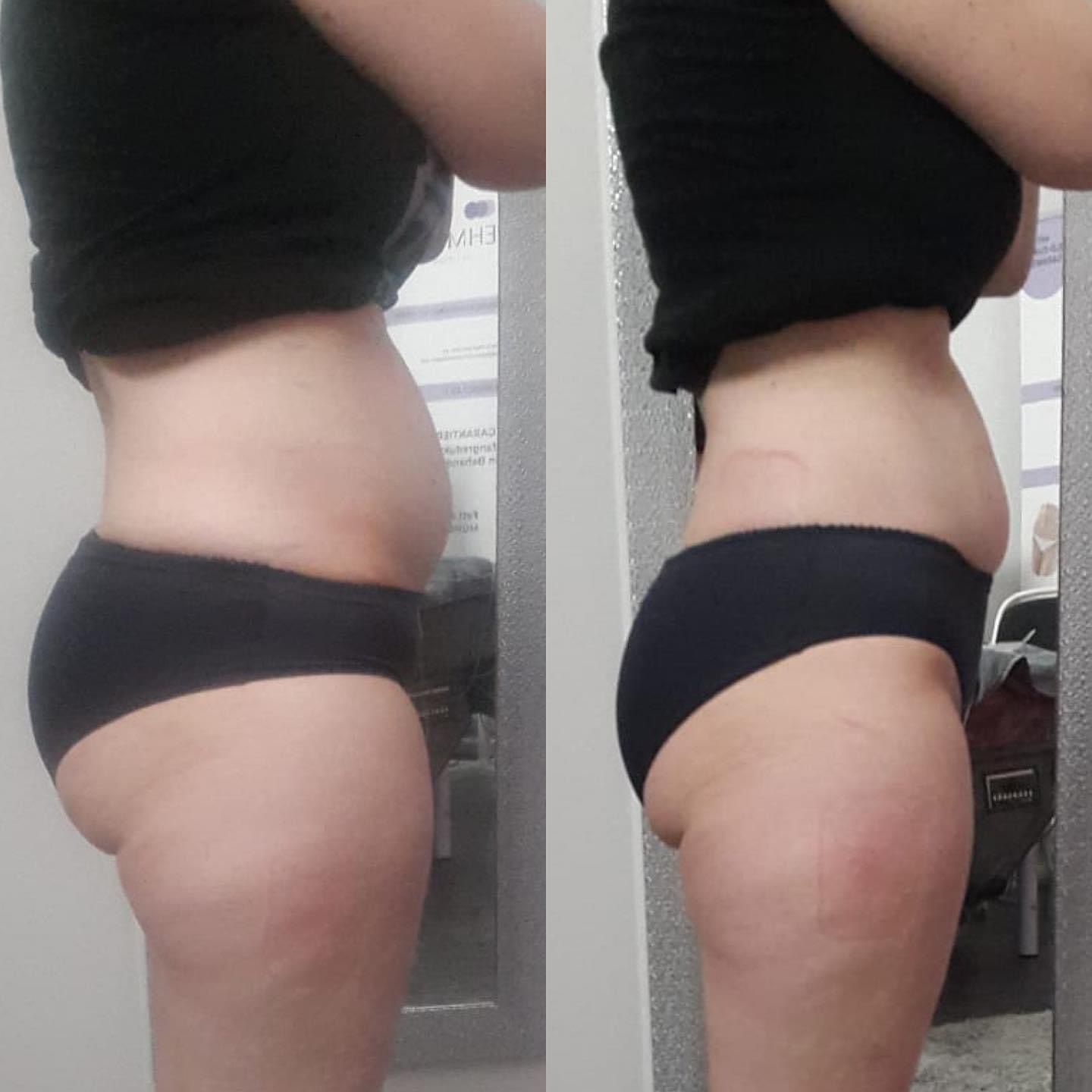 Ergebnis Bauch Seite