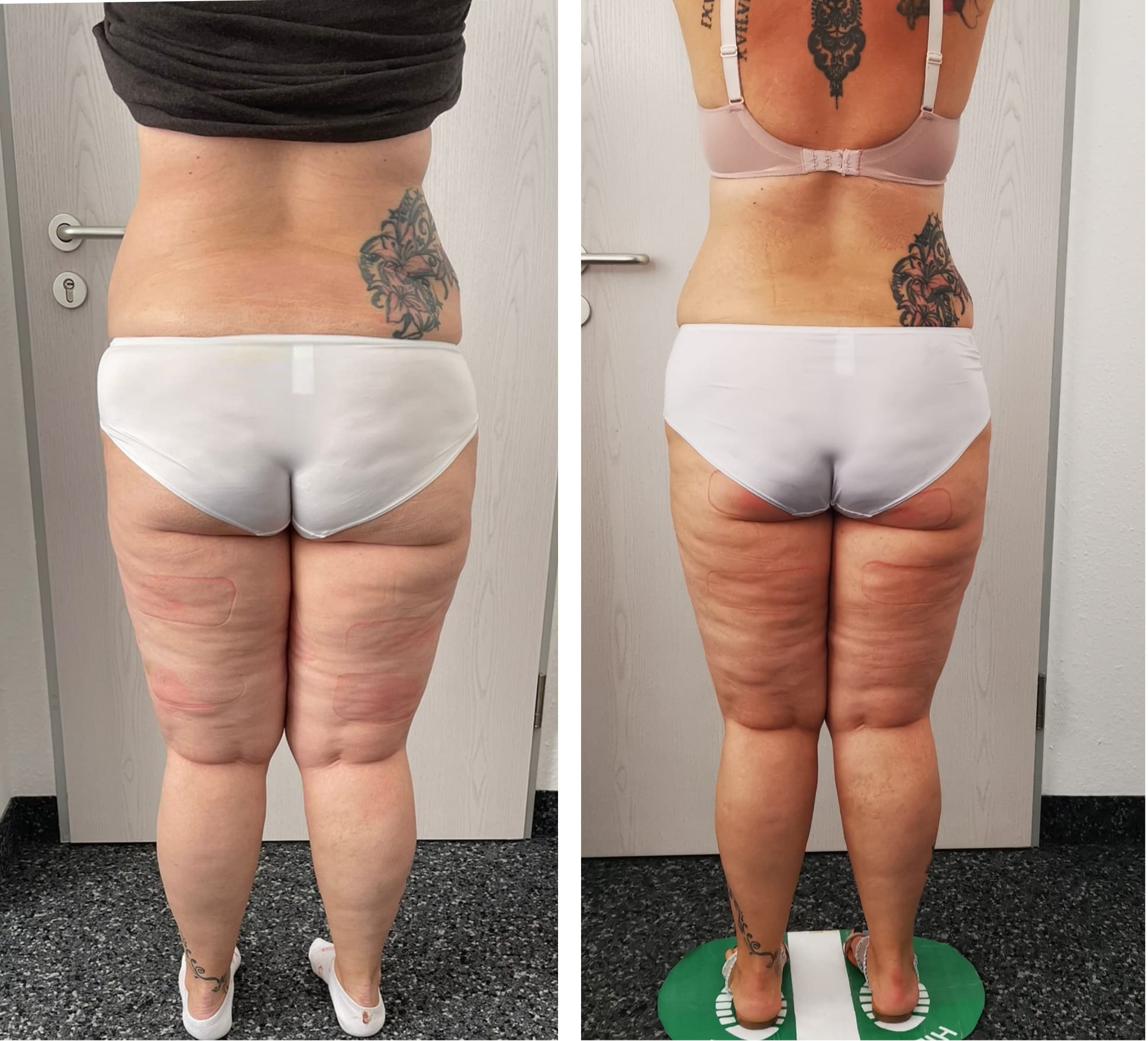 Vorher Nachher Rückansicht Beine