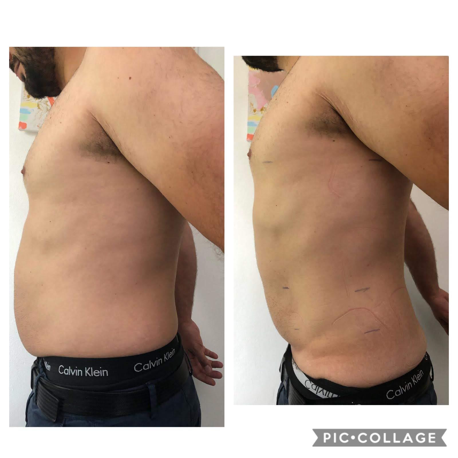 Vorher Nachher Männerbauch